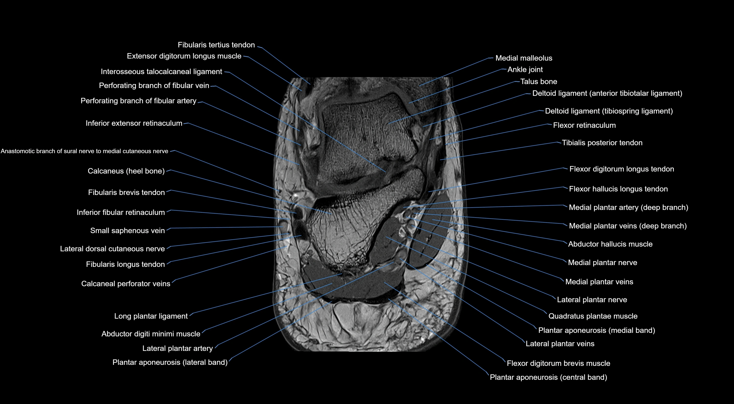 MRI mid foot coronal ligaments cross sectional anatomy 3T  radiology  image-img-00001-00047.webp